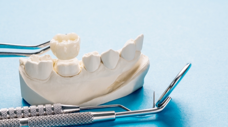 Dental crown model with tools at Vistoso Dental Partners, Oro Valley, AZ.