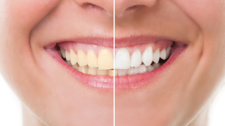 Before and after comparison of a patient's smile showing the results of professional teeth whitening at Vistoso Dental Partners in Oro Valley, AZ — left side shows stained teeth, right side shows bright, white teeth.