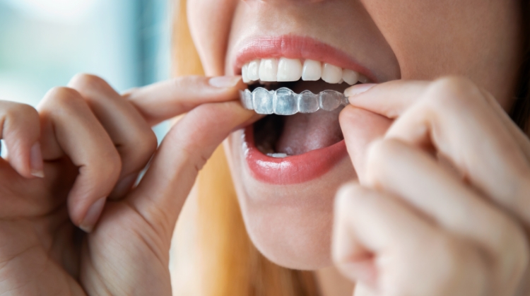 Woman inserting clear Invisalign aligners | Vistoso Dental Partners, Oro Valley, AZ